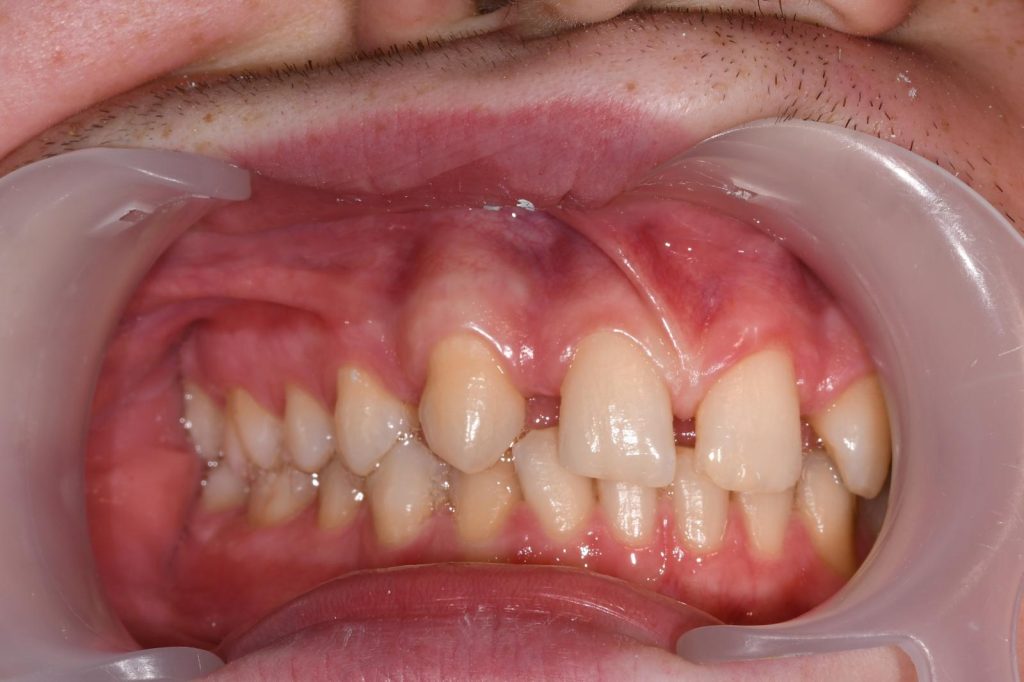 Hipodoncija - nedostatak sjekutića