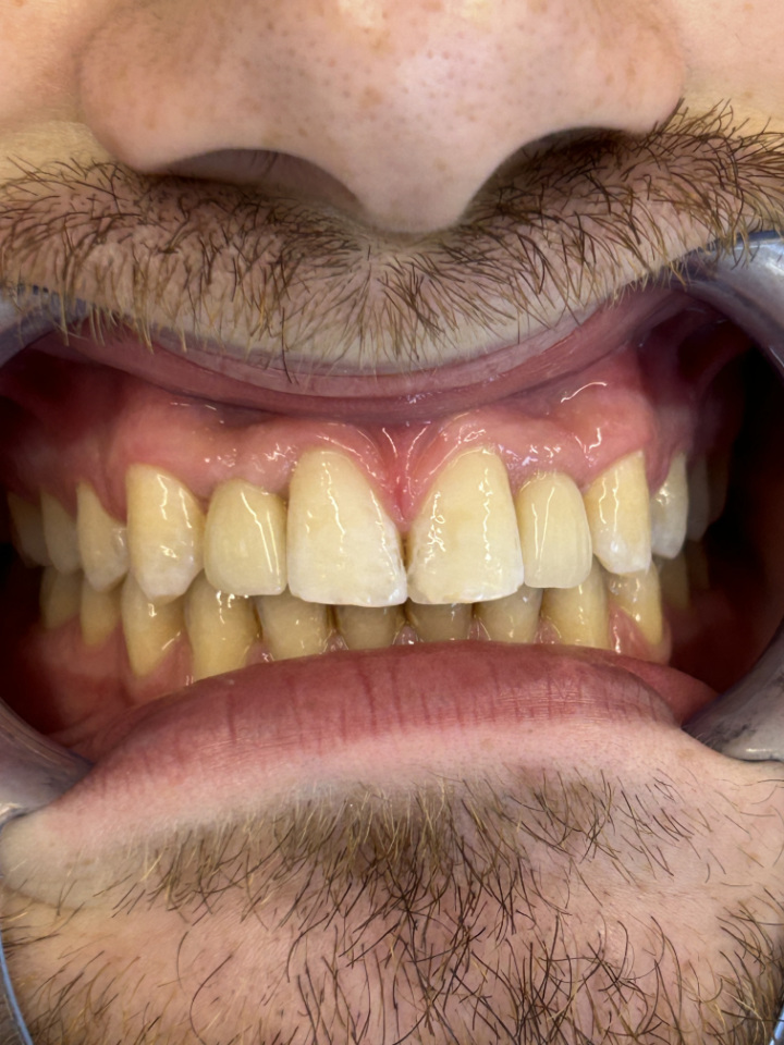 Konačni rezultat rješavanja problema hipodoncije