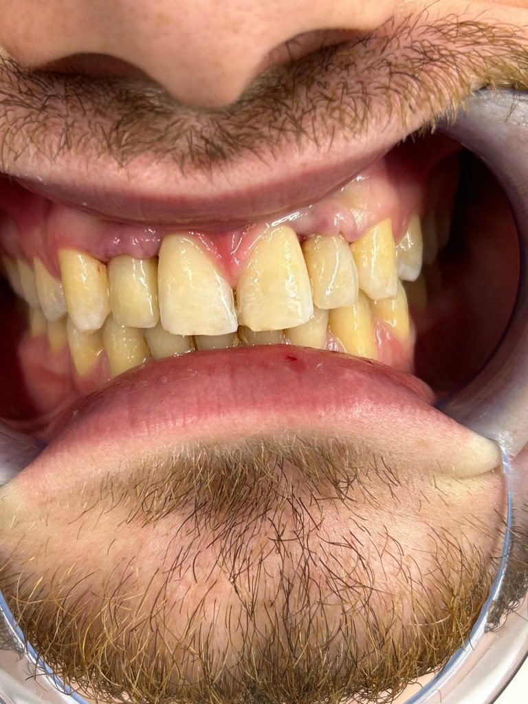 Mjesec dana nakon postavljanja privremenih krunica. Zubno meso se polako oblikuje