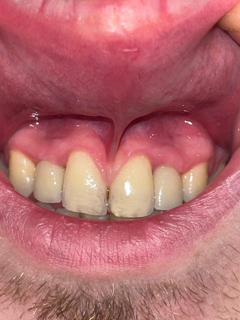 Izgled zubi nakon još 10 dana