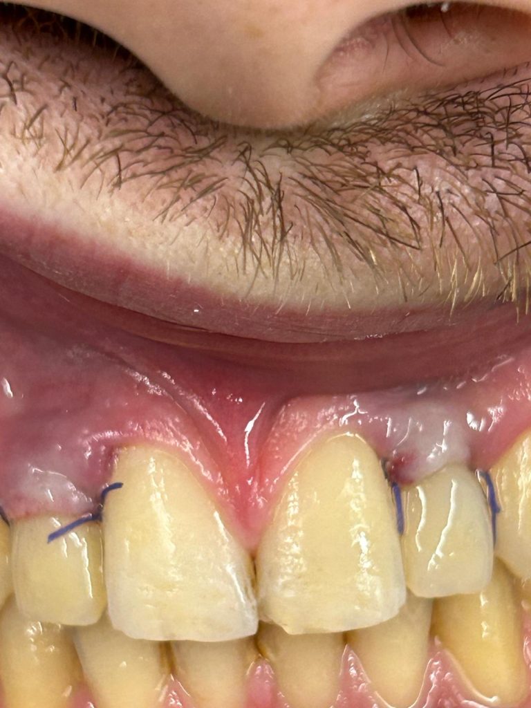 Izgled zubala nakon postavljanja privremenih krunica u procesu liječenja hipodoncije