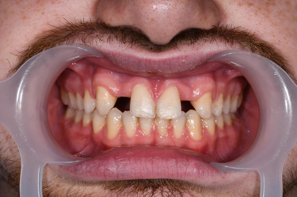 Ortodontska terapija - Hipodoncija