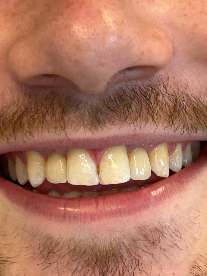 Osmijeh pacijena nakon rješavanja problema hipodoncije 🙌