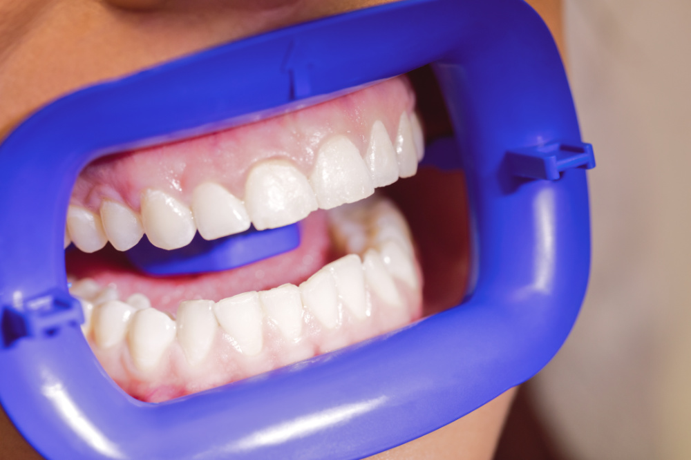 Tretman izbjeljivanja zubi u ordinaciji