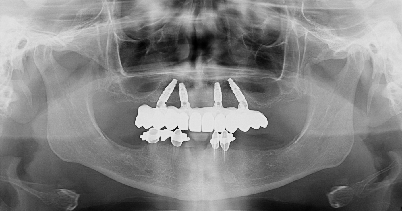 Ortopan snimka: trajni All-on-4 rad na titanskoj prečki s krunicama od cirkon-oksidne keramike