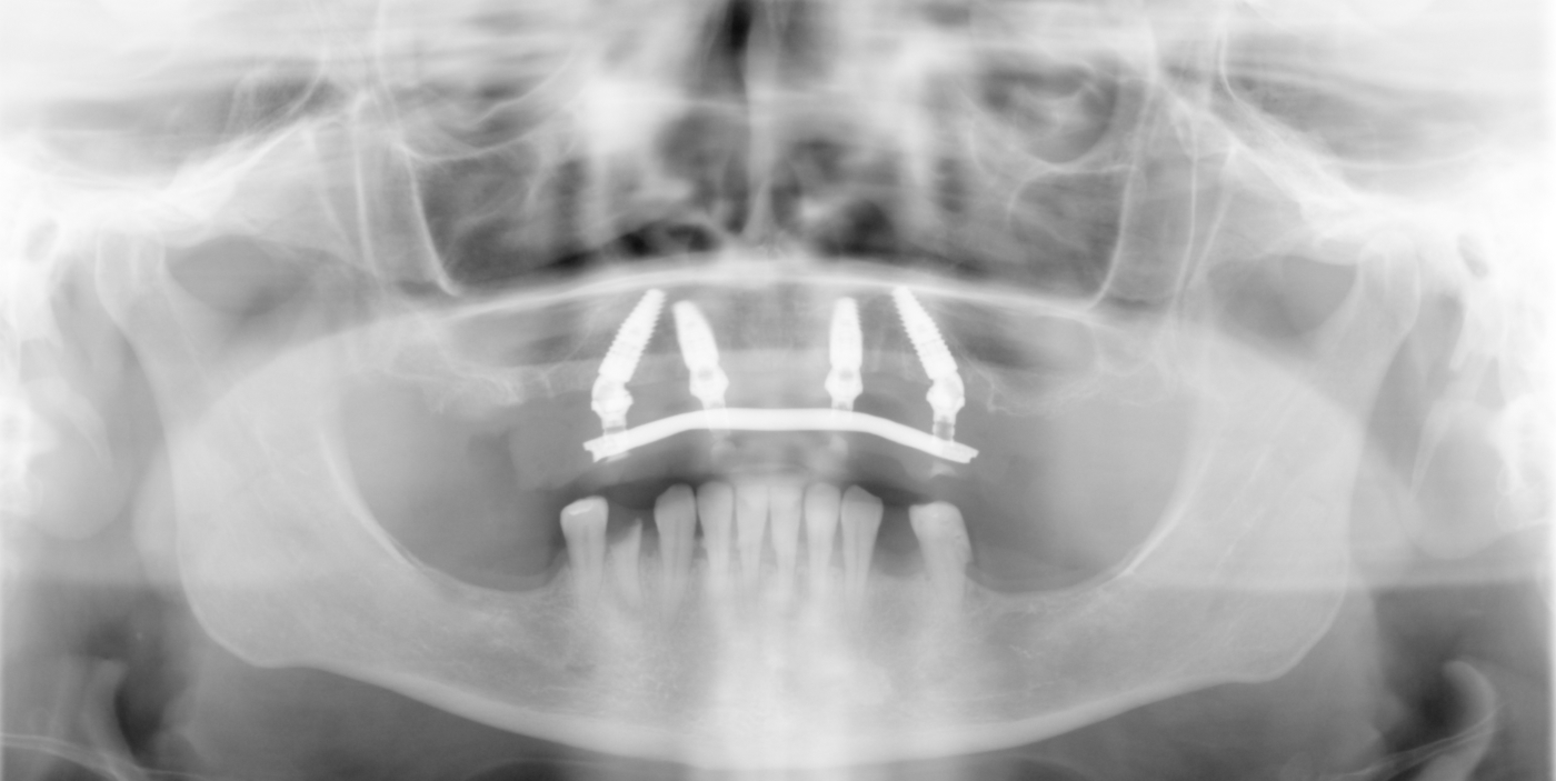 Ortopan snimka s privremenim All-on-4 radom