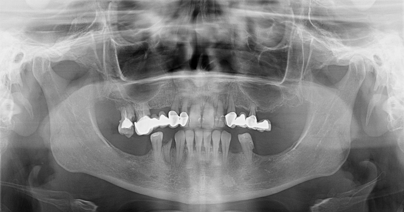 Ortopan snimka prije ugradnje All-on-4 implantata