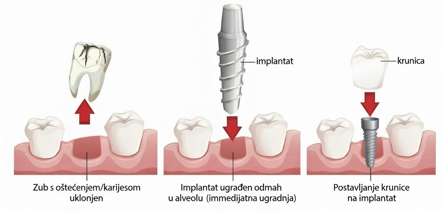 Ugradnja dentalnog implantata odmah nakon vađenja zuba