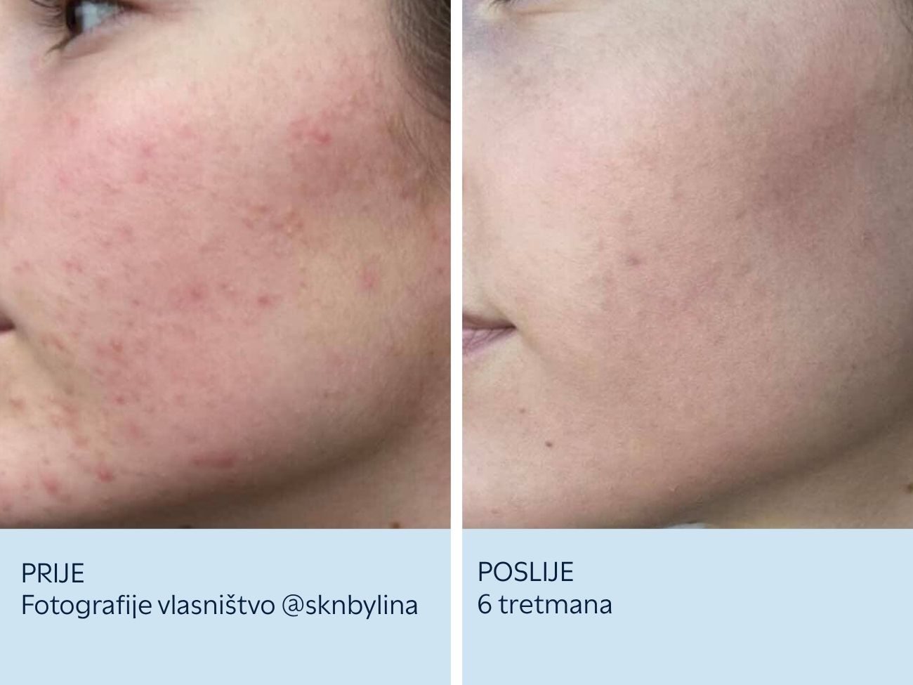 Akne i tragovi akni prije i nakon 6 SkinPen tretmana