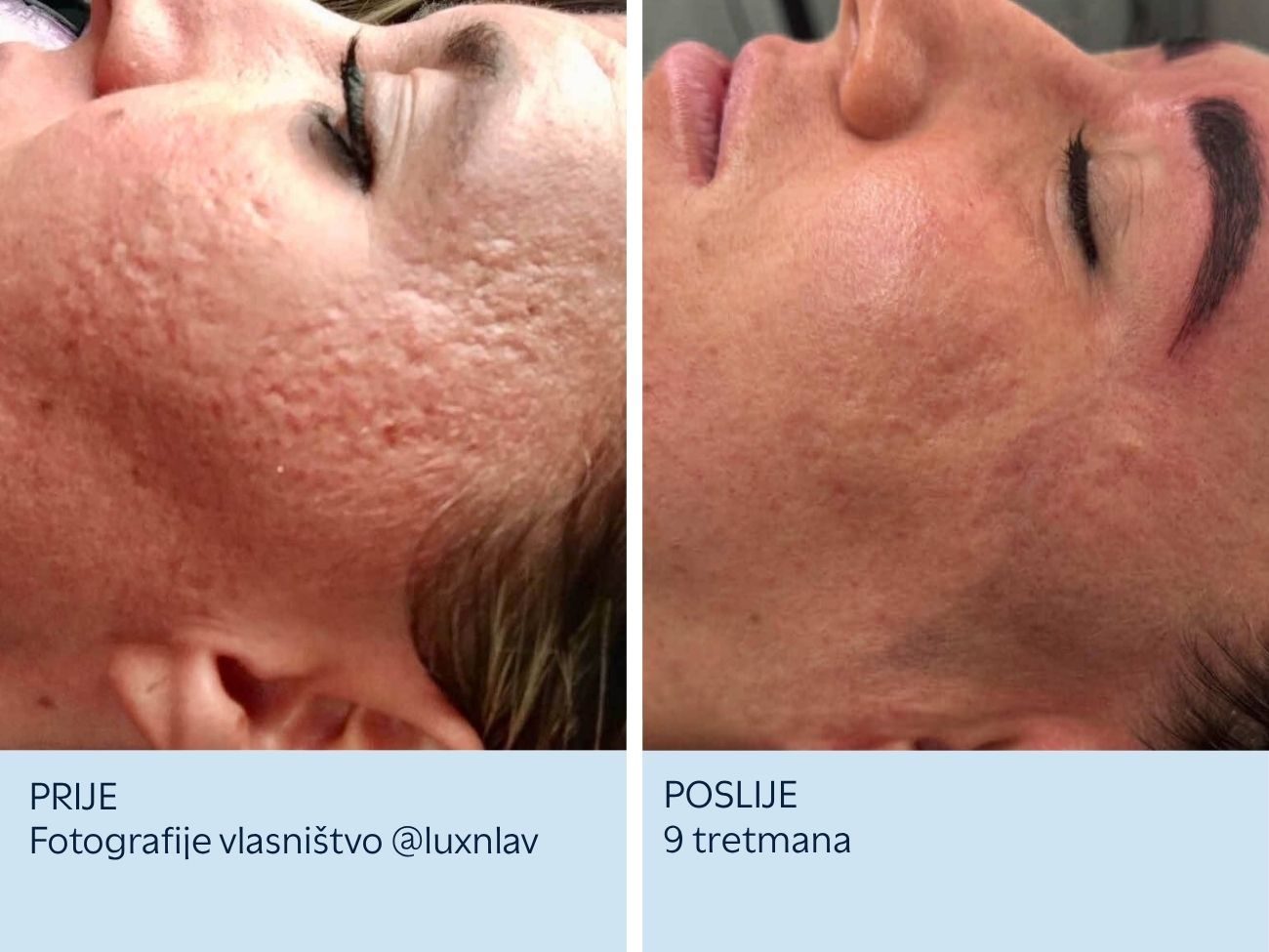 Ožiljci od akni prije i nakon 9 SkinPen tretmana