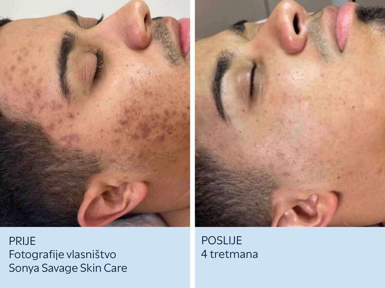 Pigmentacije na licu prije i nakon 4 SkinPen tretmana