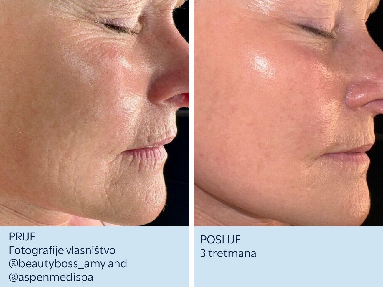Bore na licu prije i nakon 3 SkinPen tretmana