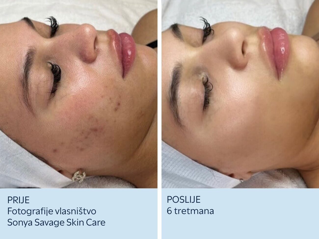 Ožiljci od akni prije i nakon 6 SkinPen tretmana
