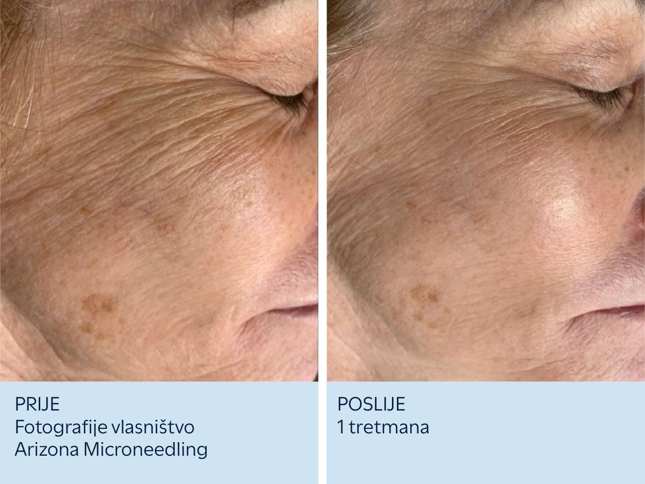 Fine linije oko očiju prije i nakon 1 SkinPen tretmana