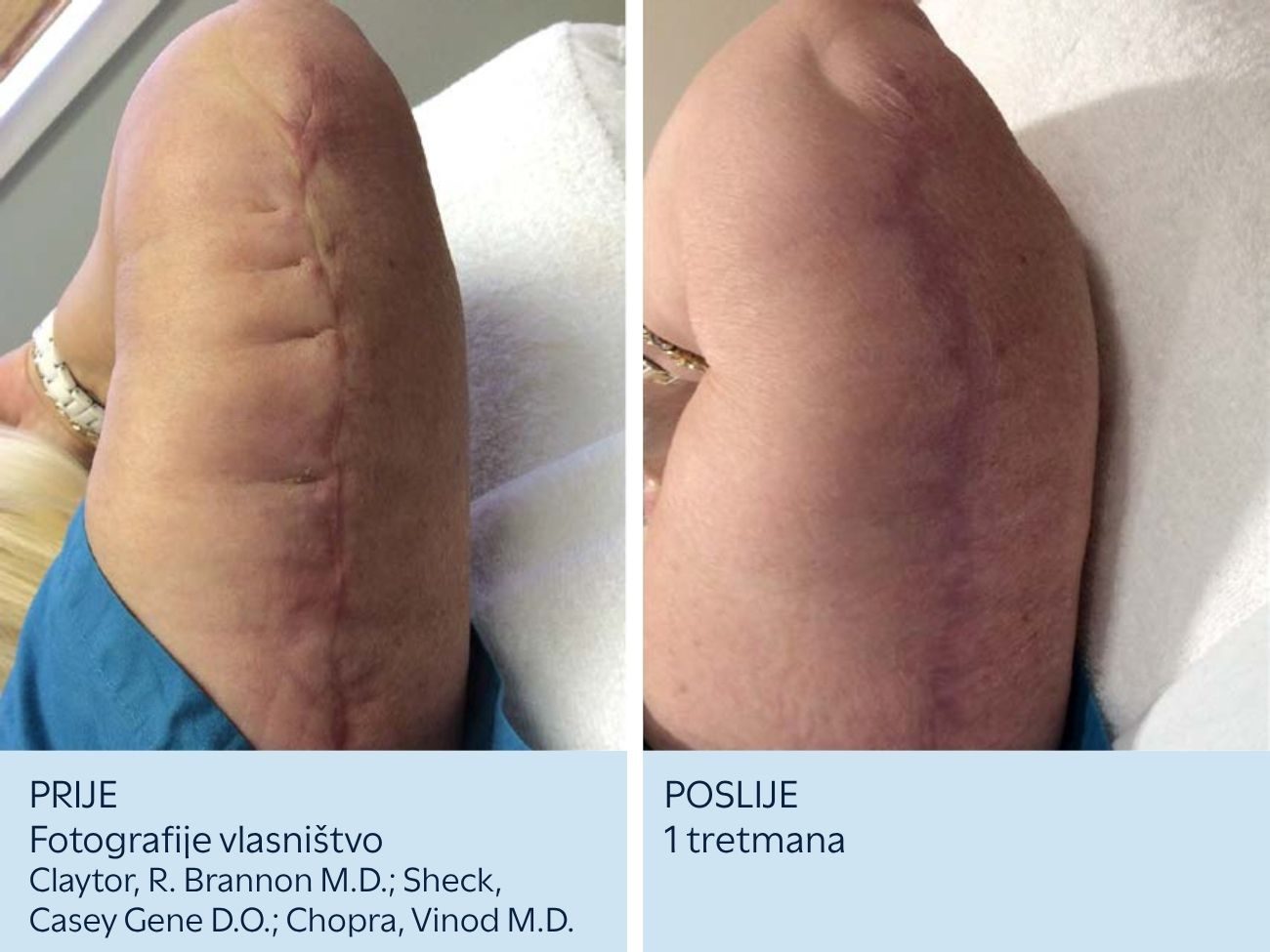 Kirurški ožiljak na nadlaktici prije i nakon SkinPen tretmana